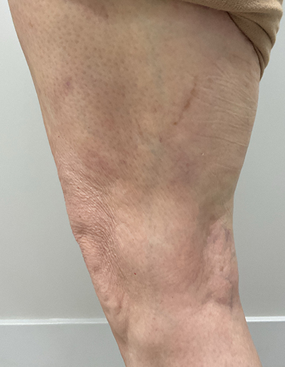 Spider Veins — Right Leg - After